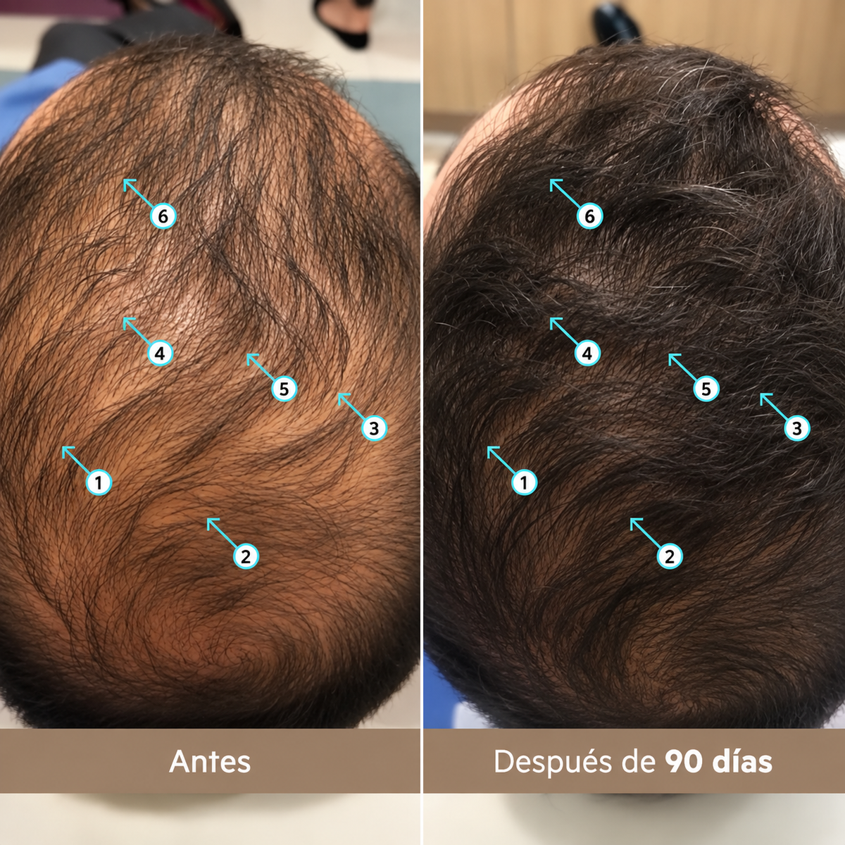 Spectral Men’s Hair Density Pro